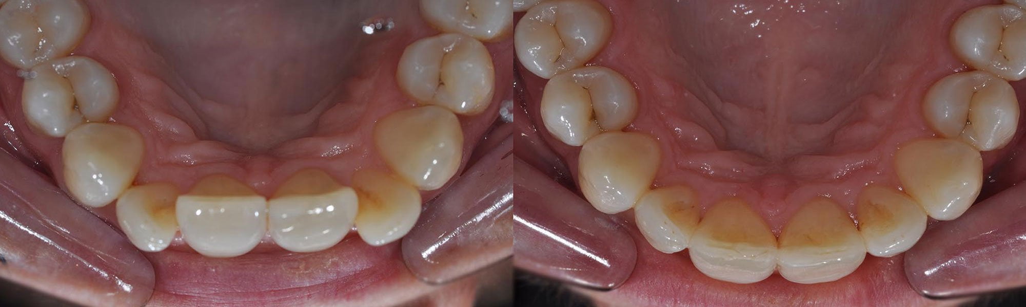 UPPER INMAN ALIGNER