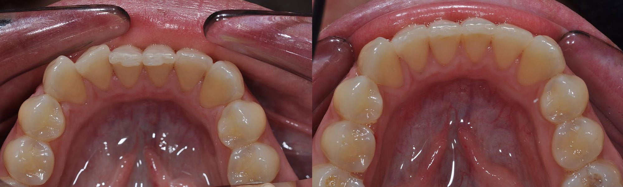 LOWER INMAN ALIGNER