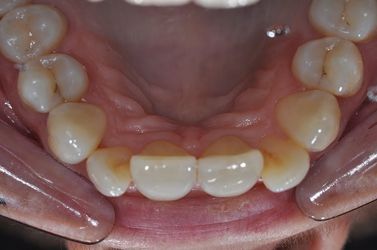 UPPER INMAN ALIGNER