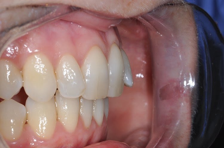 UPPER INMAN ALIGNER