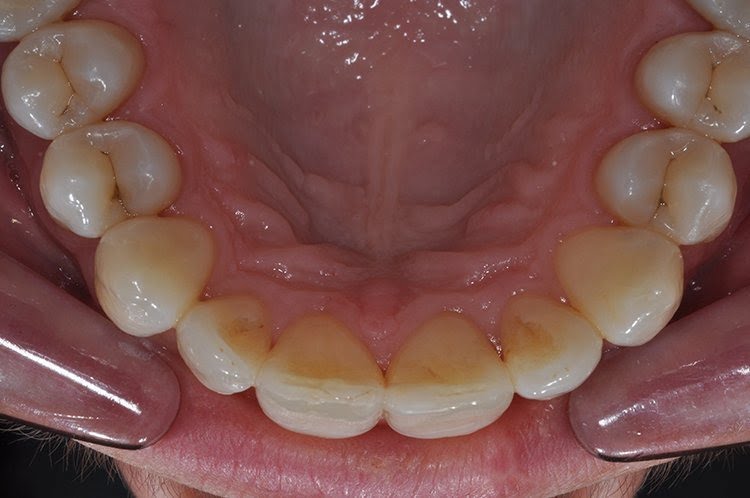 UPPER INMAN ALIGNER