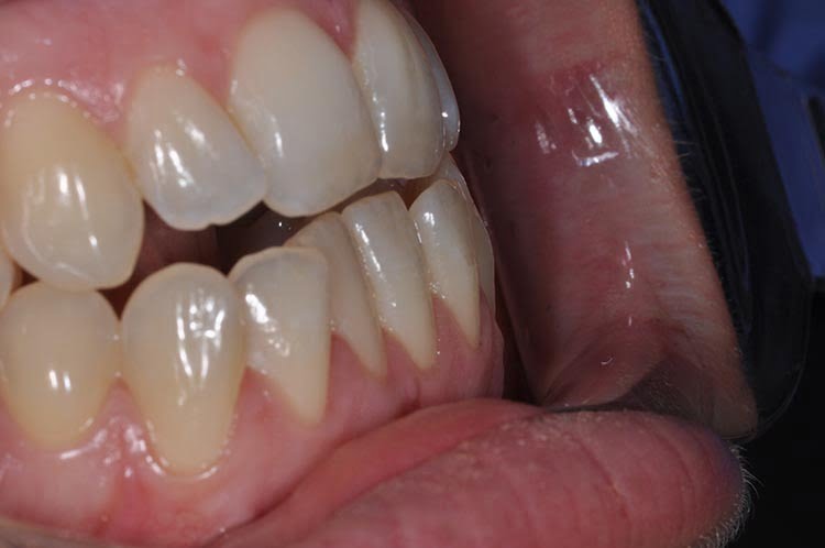 LOWER INMAN ALIGNER