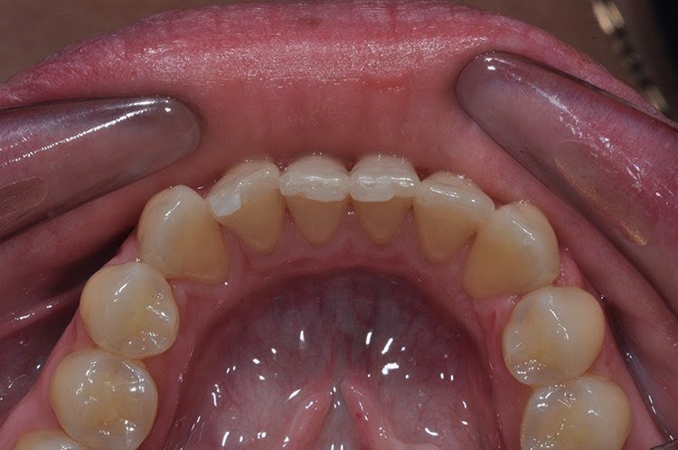 LOWER INMAN ALIGNER