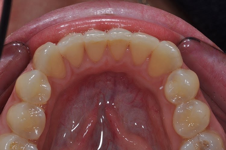 LOWER INMAN ALIGNER