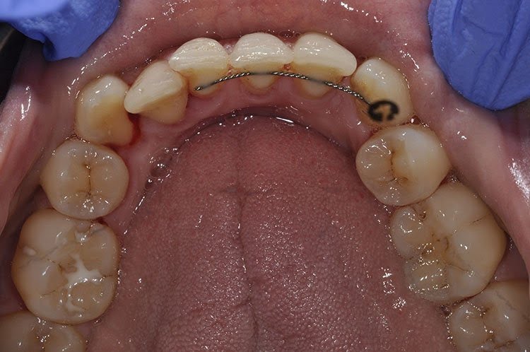 UPPER &#038; LOWER SIMPLY SMILE BRACES