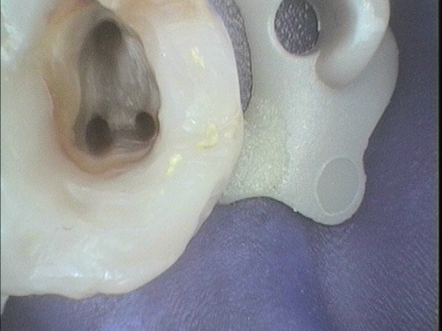 ROOT CANAL