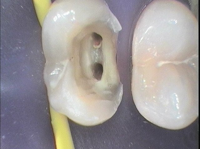 ROOT CANAL