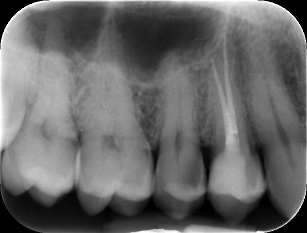 ROOT CANAL