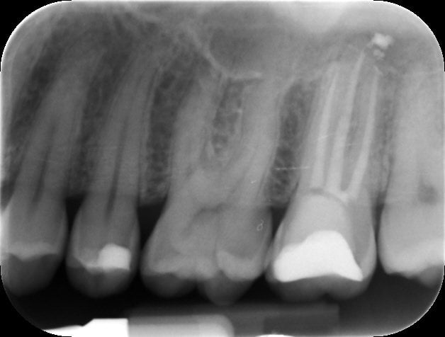 ROOT CANAL