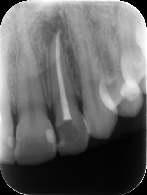 ROOT CANAL