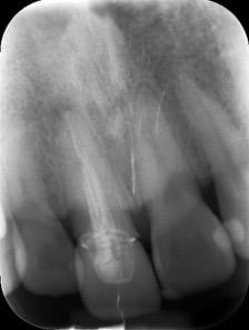 Endodontic &#8211; UR1 Retreatment
