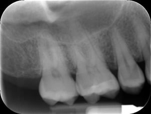 Endodontic &#8211; UR6 Cracked cusp treatment