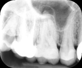 Endodontic &#8211; UR6 Minimal Access