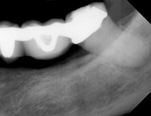 Endodontic &#8211; LL7 Through 5 unit bridge