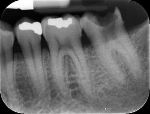 Endodontic &#8211; LL7 Retreatment