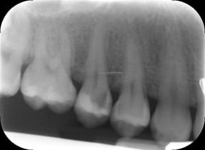 Endodontic &#8211; UR5 Primary treatment