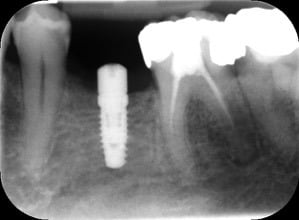 Endodontic &#8211; LL6 asymptomatic PARL