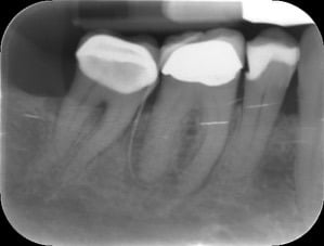 Endodontic &#8211; LR6 Through MCC