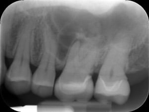 Endodontic &#8211; UL6 Through Ceramic Crown