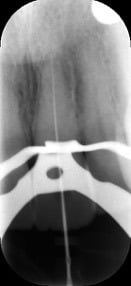 Endodontic &#8211; UL1 Sclerosed Canal