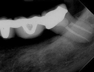 Endodontic &#8211; LL7 Through 5 unit bridge