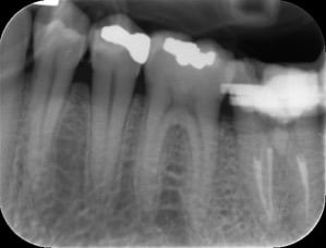 Endodontic &#8211; LL7 Retreatment
