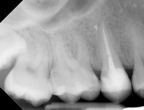 Endodontic &#8211; UR5 Primary treatment