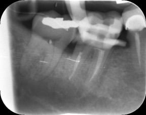 Endodontic &#8211; LR6 Deep distal caries