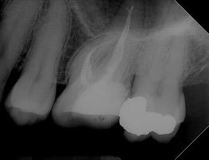 Endodontic &#8211; UL6 Patient with limited opening
