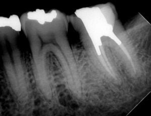 Endodontic &#8211; LL7 Retreatment