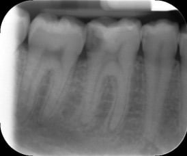 Endodontic &#8211; LL6 Primary treatment