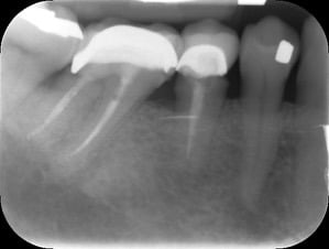 Endodontic &#8211; LR6 Deep distal caries