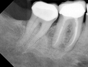 Endodontic &#8211; LR6 Through MCC