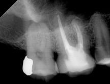 Endodontic &#8211; UR6 Missed MB2