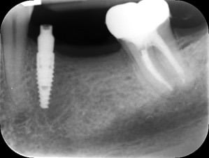 Endodontic &#8211; LL7 Primary treatment