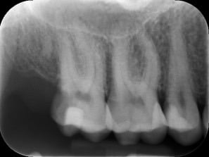 Endodontic &#8211; LL6 Primary treatment