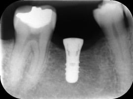 Implant &#8211; Case 1