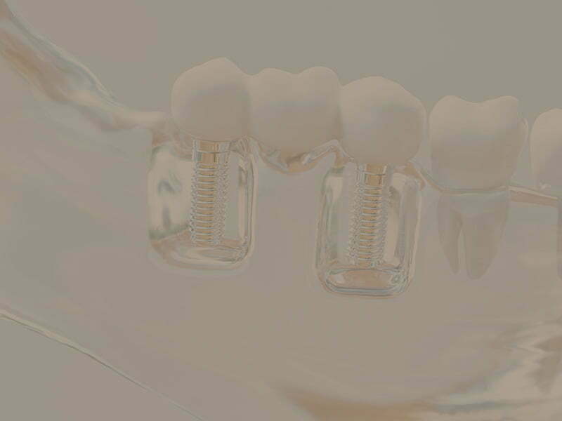 Dental Implants