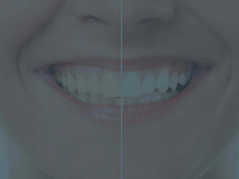 Teeth Whitening