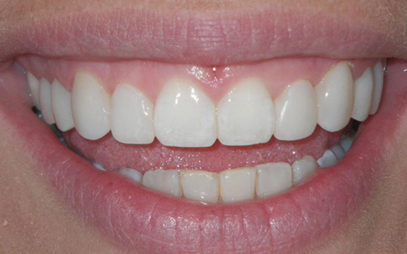 Veneer &#038; Composite Bonding Smile Gallery