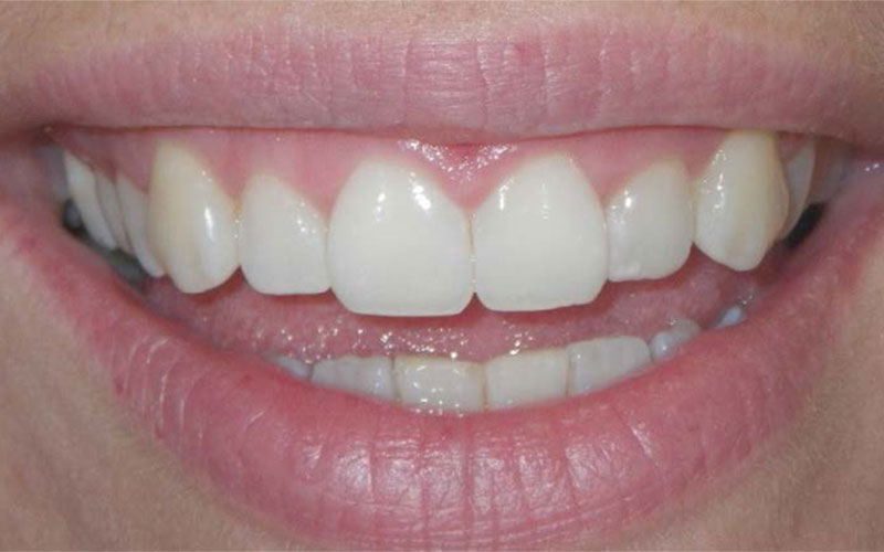 Veneer &#038; Composite Bonding Smile Gallery
