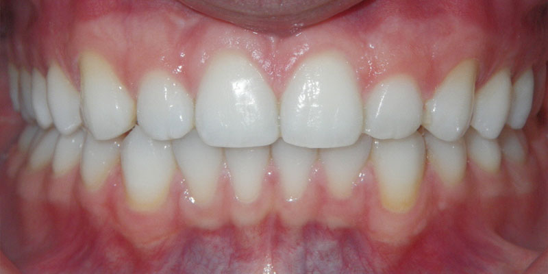 Invisalign Smile Gallery