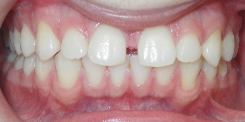 Invisalign Smile Gallery