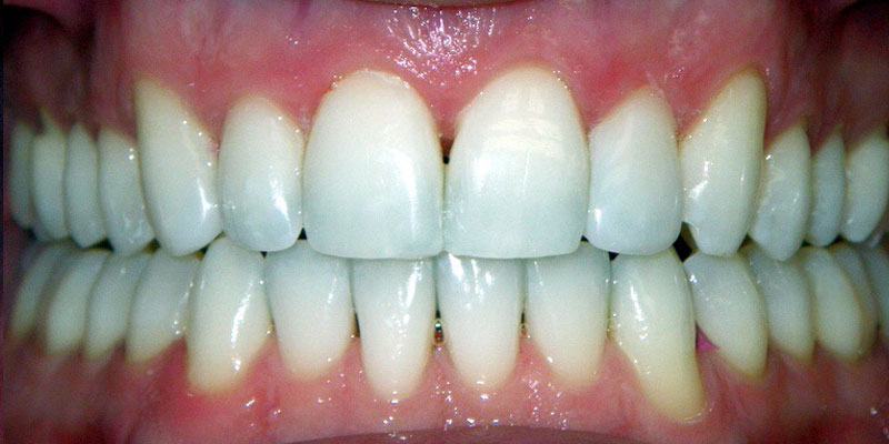 Invisalign Smile Gallery