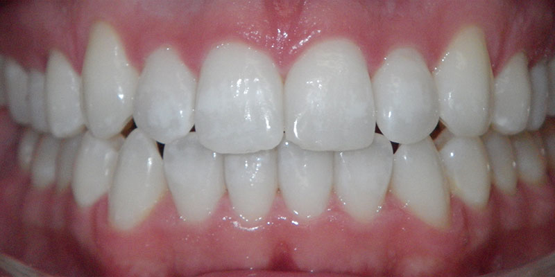 Invisalign Smile Gallery