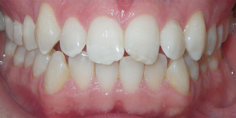 Invisalign Smile Gallery