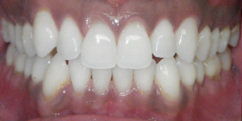 Invisalign Smile Gallery