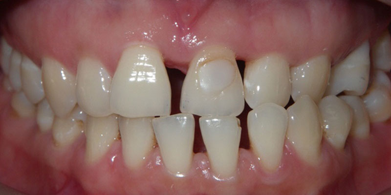 Invisalign Smile Gallery