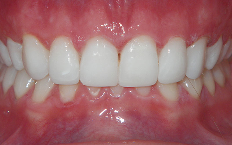 Veneer &#038; Composite Bonding Smile Gallery