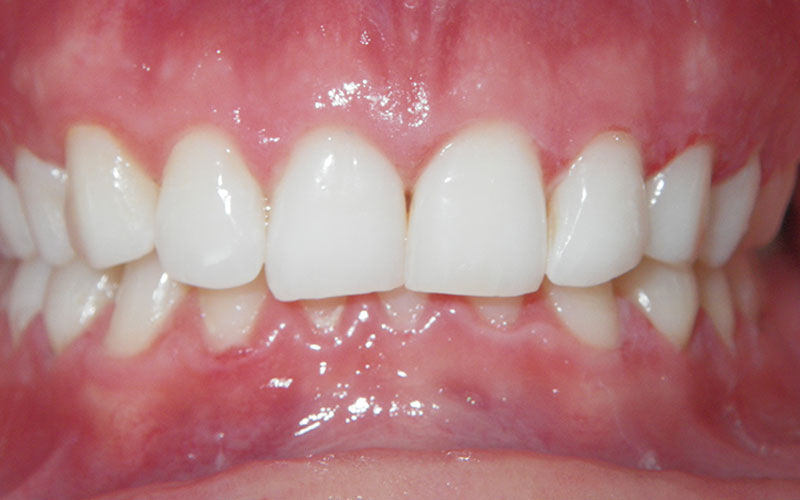 Veneer &#038; Composite Bonding Smile Gallery